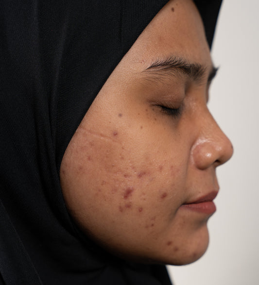 Solusi kulit kering berjerawat