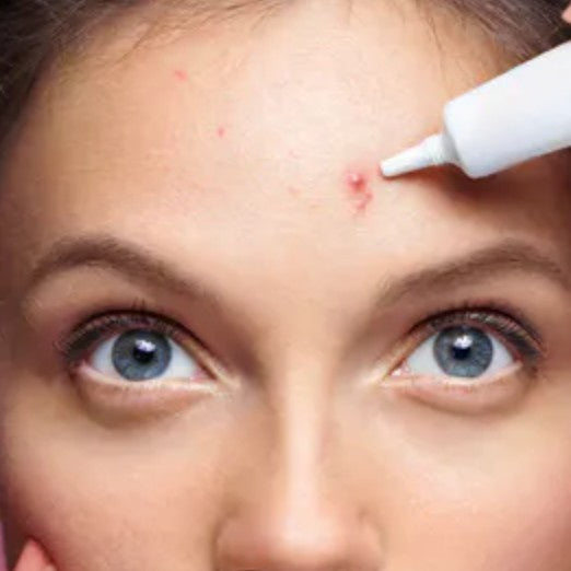 Mineral Botanica Zit Zapper For Acne 15g (Obat totol jerawat)